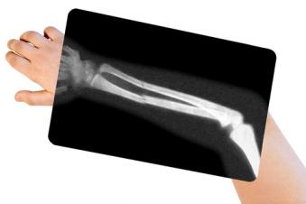 r4tqv5svbmlfc0pgolvafep265FA fracture1